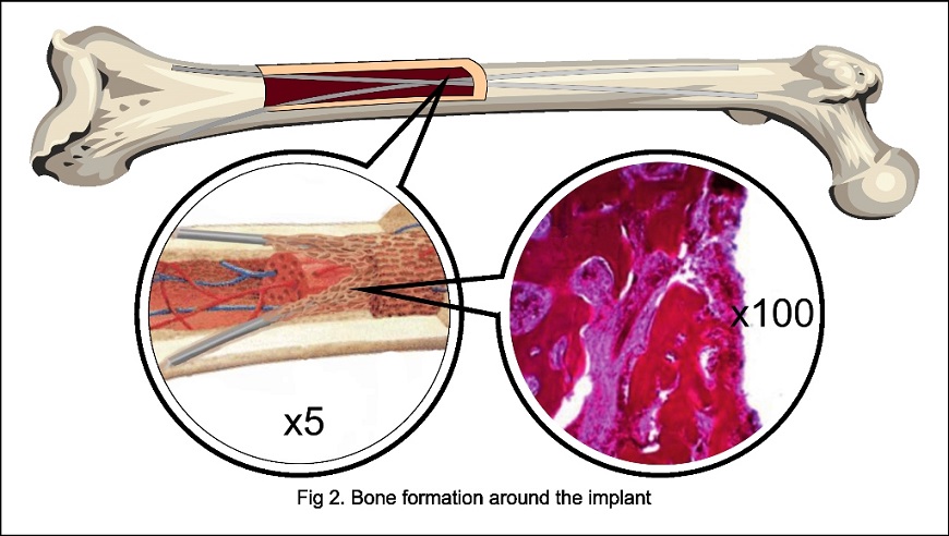 Implants for lel lengthening